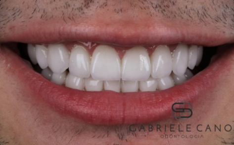 Sorriso depois do tratamento estético